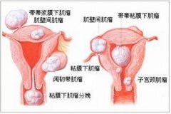 如何预防子宫癌